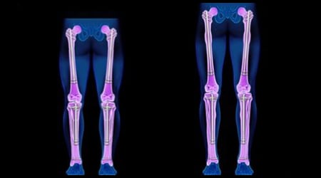 COMBINED TIBIA & FEMUR
